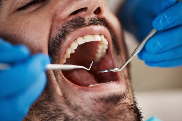 Best Emergency Wisdom Teeth Removal in Fairlawn, VA