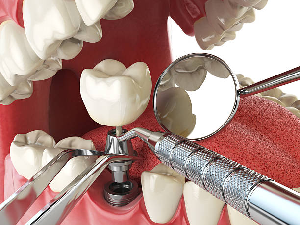 Best Emergency Broken Tooth Repair in Fairlawn, VA